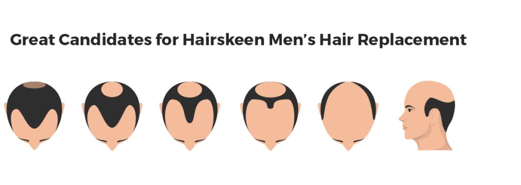 Men's Hair Replacement Services in Dallas