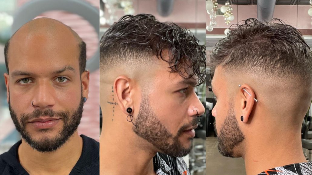 Mens hair replacement service Dallas